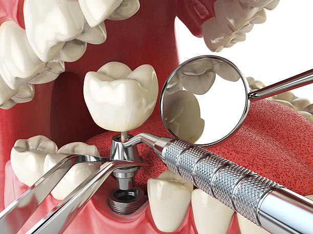 Best Broken or Cracked Tooth Emergency Dentist in Great Neck, NY